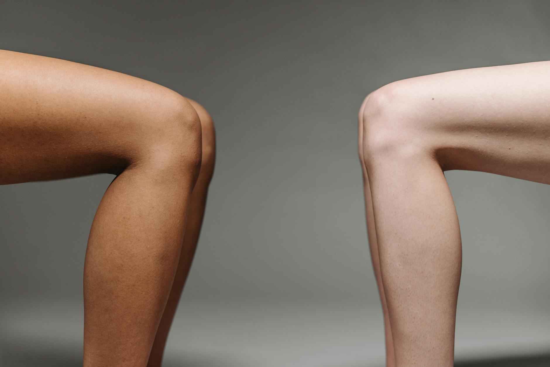 Kene Saldırısında Ne Yapmalı? Bilmeniz Gerekenler